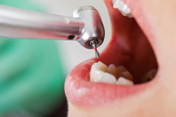 Best Emergency Treatment for Dental Infections or Abscesses in Erwin, NC